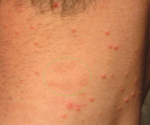 Molluscum contagiosum before treatment