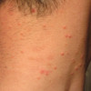 Picture of molluscum bumps 1 week before treatment