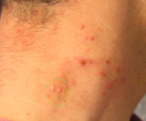 Molluscum contagiosum 3 days after treatment