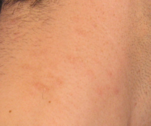 Molluscum contagiosum 11 days after treatment